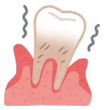 口唇圧と舌圧（舌が押す力）により歯がずれているイラスト